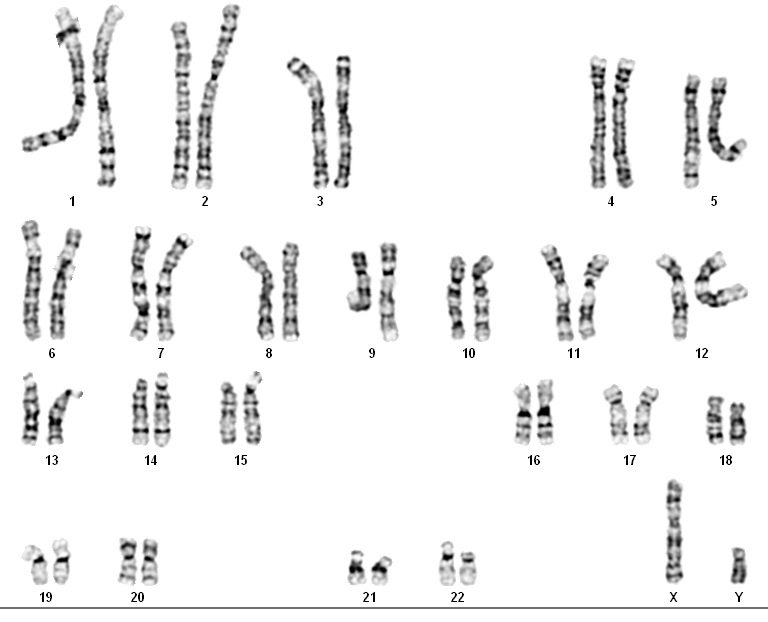 Karyotype Pictures Of Spina Bifida 48